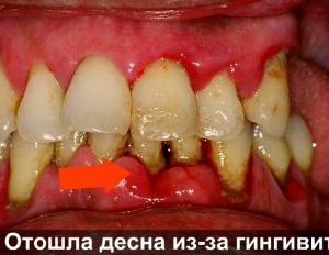 Десна відійшла від зуба: яких заходів вжити